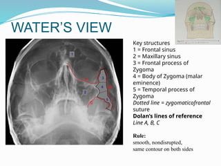 WATER’S VIEW
Rule:
smooth, nondisrupted,
same contour on both sides
Key structures
1 = Frontal sinus
2 = Maxillary sinus
3 = Frontal process of
Zygoma
4 = Body of Zygoma (malar
eminence)
5 = Temporal process of
Zygoma
Dotted line = zygomaticofrontal
suture
Dolan’s lines of reference
Line A, B, C
 