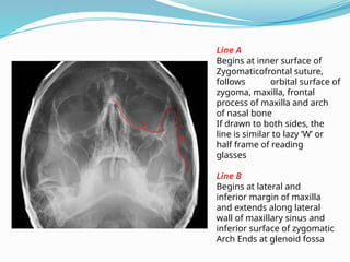 Line A
Begins at inner surface of
Zygomaticofrontal suture,
follows orbital surface of
zygoma, maxilla, frontal
process of maxilla and arch
of nasal bone
If drawn to both sides, the
line is similar to lazy ‘W’ or
half frame of reading
glasses
Line B
Begins at lateral and
inferior margin of maxilla
and extends along lateral
wall of maxillary sinus and
inferior surface of zygomatic
Arch Ends at glenoid fossa
 