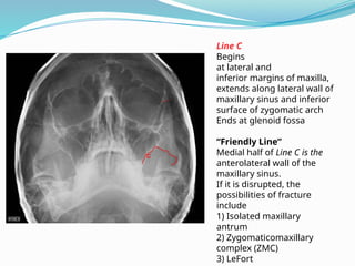 Line C
Begins
at lateral and
inferior margins of maxilla,
extends along lateral wall of
maxillary sinus and inferior
surface of zygomatic arch
Ends at glenoid fossa
“Friendly Line”
Medial half of Line C is the
anterolateral wall of the
maxillary sinus.
If it is disrupted, the
possibilities of fracture
include
1) Isolated maxillary
antrum
2) Zygomaticomaxillary
complex (ZMC)
3) LeFort
 
