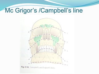 Mc Grigor’s /Campbell’s line
 