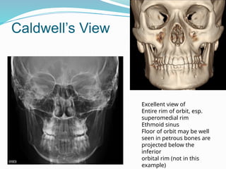 Caldwell’s View
Excellent view of
Entire rim of orbit, esp.
superomedial rim
Ethmoid sinus
Floor of orbit may be well
seen in petrous bones are
projected below the
inferior
orbital rim (not in this
example)
 
