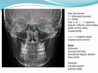 Key structures
1 = Ethmoid sinuses
2 = Orbit
Line A, B, C, D = superior,
lateral, inferior and medial
walls of the orbit,
respectively
Line E = midline nasal
septum and vomer
Rule:
Ethmoid
sinuses density
should be equal, darker
than orbit
Smooth
nondisrupted
orbital walls
2
 