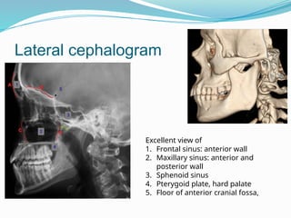 Lateral cephalogram
Excellent view of
1. Frontal sinus: anterior wall
2. Maxillary sinus: anterior and
posterior wall
3. Sphenoid sinus
4. Pterygoid plate, hard palate
5. Floor of anterior cranial fossa,
 