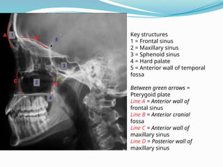 Key structures
1 = Frontal sinus
2 = Maxillary sinus
3 = Sphenoid sinus
4 = Hard palate
5 = Anterior wall of temporal
fossa
Between green arrows =
Pterygoid plate
Line A = Anterior wall of
frontal sinus
Line B = Anterior cranial
fossa
Line C = Anterior wall of
maxillary sinus
Line D = Posterior wall of
maxillary sinus
 
