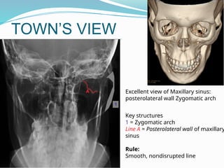TOWN’S VIEW
Key structures
1 = Zygomatic arch
Line A = Posterolateral wall of maxillary
sinus
Rule:
Smooth, nondisrupted line
Excellent view of Maxillary sinus:
posterolateral wall Zygomatic arch
 