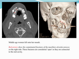 Middle age women fell onto her mouth.
Red arrows show the comminuted fractures of the maxillary alveolar process
on the right side. These fractures are considered ‘open’ as they are connected
to the oral cavity.
 
