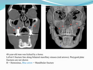 48-year-old man was kicked by a horse.
LeFort I fracture line along bilateral maxillary sinuses (red arrows). Pterygoid plate
fractures are not shown
H = Hemosinus, Blue arrow = Mandibular fracture
 