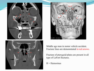 Middle age man in motor vehicle accident.
Fracture lines are demonstrated in red arrows.
Fracture of pterygoid plates are present in all
type of LeFort fractures.
H = Hemosinus
 