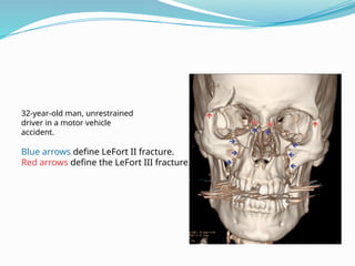 32-year-old man, unrestrained
driver in a motor vehicle
accident.
Blue arrows define LeFort II fracture.
Red arrows define the LeFort III fracture.
 