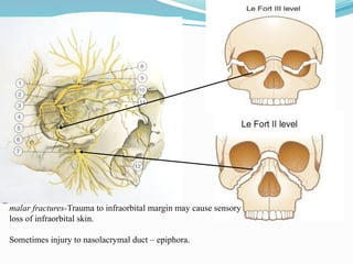 malar fractures-Trauma to infraorbital margin may cause sensory
loss of infraorbital skin.
Sometimes injury to nasolacrymal duct – epiphora.
 