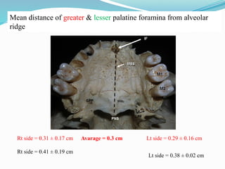 Mean distance of greater & lesser palatine foramina from alveolar
ridge
Rt side = 0.31 ± 0.17 cm Lt side = 0.29 ± 0.16 cm
Avarage = 0.3 cm
Rt side = 0.41 ± 0.19 cm
Lt side = 0.38 ± 0.02 cm
 