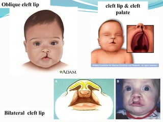 Oblique cleft lip
Bilateral cleft lip
cleft lip & cleft
palate
 