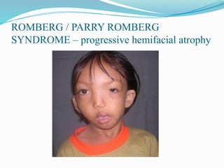 ROMBERG / PARRY ROMBERG
SYNDROME – progressive hemifacial atrophy
 