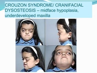 CROUZON SYNDROME/ CRANIFACIAL
DYSOSTEOSIS – midface hypoplasia,
underdeveloped maxilla
 