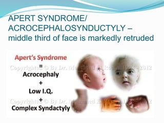 APERT SYNDROME/
ACROCEPHALOSYNDUCTYLY –
middle third of face is markedly retruded
 