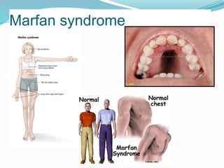 Marfan syndrome
 