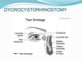 DYCROCYSTORHINOSTOMY
 