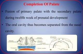 Completion Of Palate
• Fusion of primary palate with the secondary palate
during twelfth week of prenatal development
• The oral cavity thus becomes separated from the nasal
cavity.
44
 