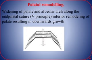 Palatal remodelling.
Widening of palate and alveolar arch along the
midpalatal suture (V principle) inferior remodeling of
palate resulting in downwards growth
50
 