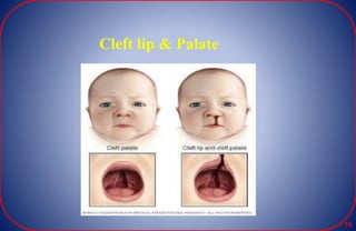 Cleft lip & Palate
79
 