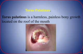 Torus Palatinus.
Torus palatinus is a harmless, painless bony growth
located on the roof of the mouth
80
 