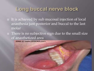  It is achieved by sub mucosal injection of local
anasthesia just posterior and buccal to the last
molar
 There is no subjective sign due to the small size
of anasthetized area
 