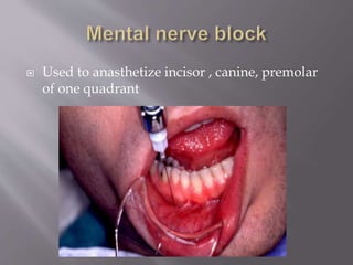  Used to anasthetize incisor , canine, premolar
of one quadrant
 