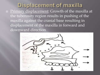  Primary displacement: Growth of the maxilla at
the tuberosity region results in pushing of the
maxilla against the cranial base resulting in
displacement of the maxilla in forward and
downward direction
 