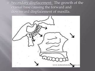  Secondary displacement: The growth of the
cranial base causing the forward and
downward displacement of maxilla.
 