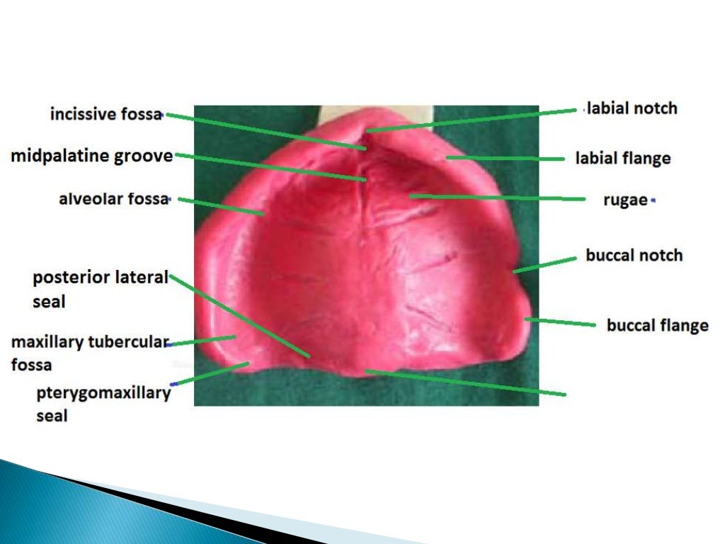 Maxillary denturelandmarks