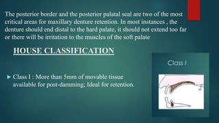 HOUSE CLASSIFICATION
 Class I : More than 5mm of movable tissue
available for post-damming; Ideal for retention.
The posterior border and the posterior palatal seal are two of the most
critical areas for maxillary denture retention. In most instances , the
denture should end distal to the hard palate, it should not extend too far
or there will be irritation to the muscles of the soft palate
 