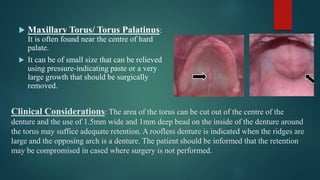 Clinical Considerations: The area of the torus can be cut out of the centre of the
denture and the use of 1.5mm wide and 1mm deep bead on the inside of the denture around
the torus may suffice adequate retention. A roofless denture is indicated when the ridges are
large and the opposing arch is a denture. The patient should be informed that the retention
may be compromised in cased where surgery is not performed.
 Maxillary Torus/ Torus Palatinus:
It is often found near the centre of hard
palate.
 It can be of small size that can be relieved
using pressure-indicating paste or a very
large growth that should be surgically
removed.
 