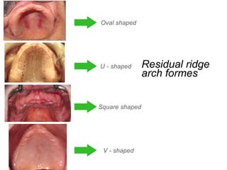 Oval shaped
Square shaped
U - shaped
V - shaped
Residual ridge
arch formes
 