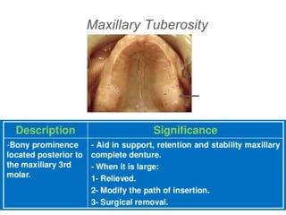 Maxillary Tuberosity
 