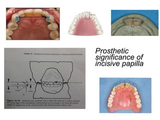 Prosthetic
significance of
incisive papilla
 