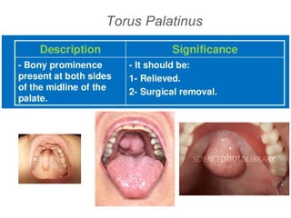Torus Palatinus
 