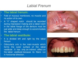 Labial Frenum
 