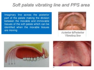 Soft palate vibrating line and PPS area
 