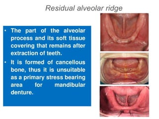 Residual alveolar ridge
 
