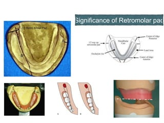 Significance of Retromolar pad
 