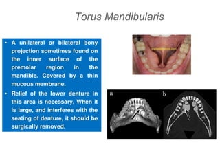 Torus Mandibularis
 