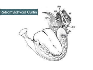 Retromylohyoid Curtin
 
