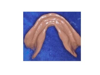 Maxillary and mandibular anatomical land marks