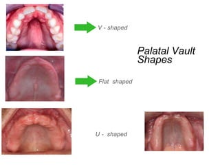 Flat shaped
Palatal Vault
Shapes
U - shaped
V - shaped
 