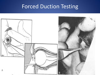 Maxillary and periorbital fractures | PPTX