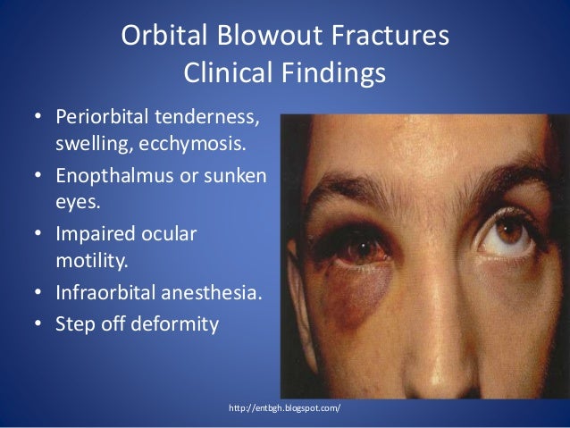 Maxillary and periorbital fractures