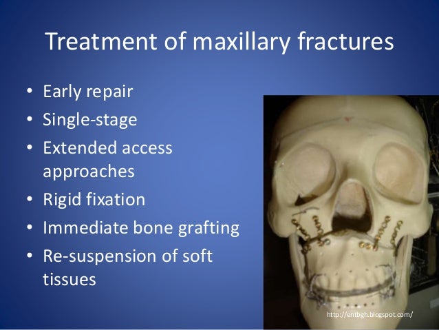 Maxillary Fracture