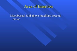 Area of Insertion Mucobuccal fold above maxillary second molar 