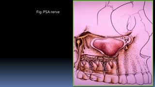 Fig: PSA nerve
 