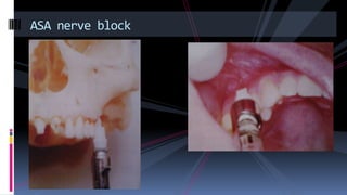 ASA nerve block
 